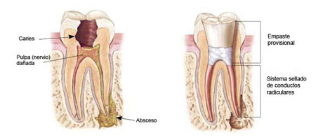 Endodoncia