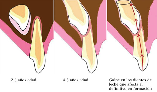 Golpe dientes de leche