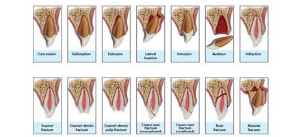 Golpes en los dientes