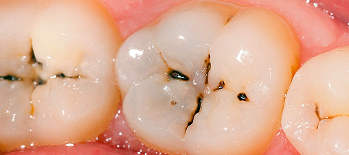 Resultado de imagen de caries