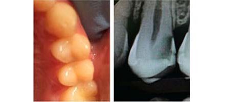 Caries entre los dientes