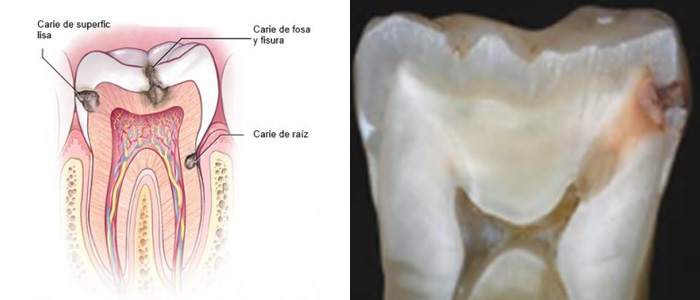 Pulpa dental infección. Fases endodoncia