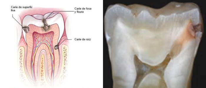 Caries Dental