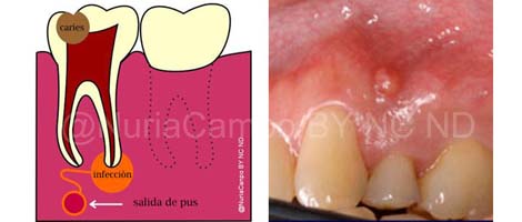 Pulpa Dental Infecctada