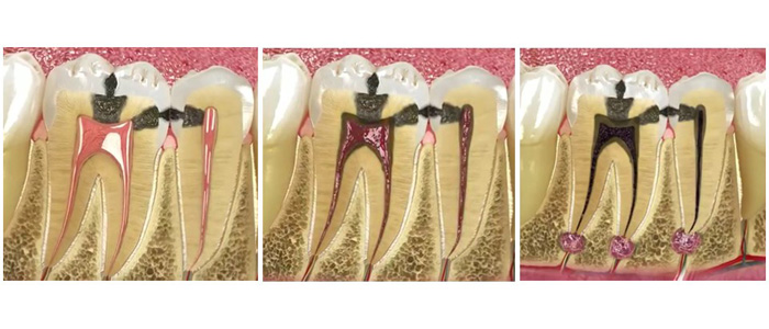 Pulpa Dental Infectada