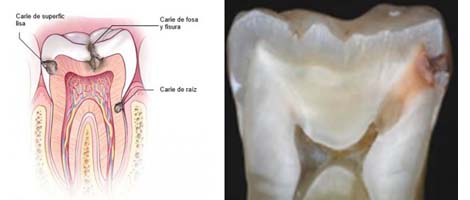 Caries Dental, Inflamación Dental