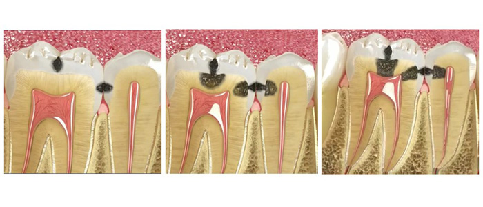 Pulpa Dental Inflamada