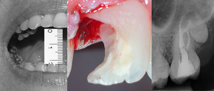 Dificultad en endodoncia