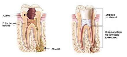 Endodoncia