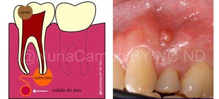 Pulpa Dental Infecctada